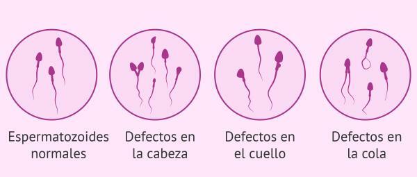 Types of sperm - Types of sperm according to their morphology