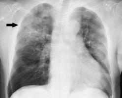 The 3 differences between pneumonia and bronchitis