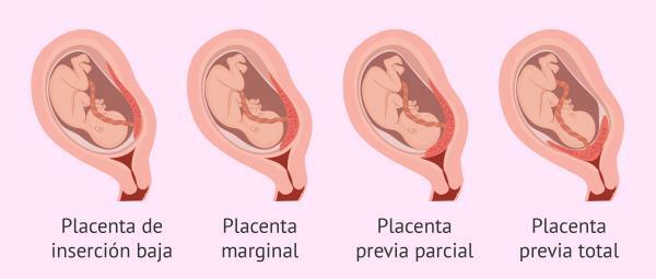 Функция на плацентата - Видове плацента 