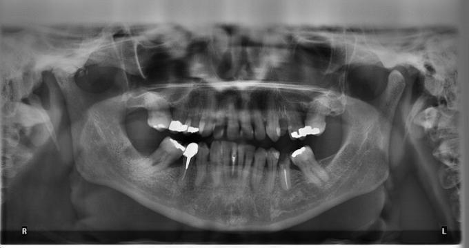 zubni amalgam