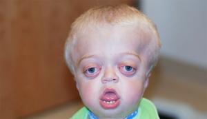 Pfeiffer syndrome: causes, symptoms and treatments
