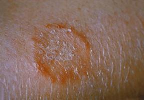 Les 24 maladies de la peau: les caractéristiques et comment les reconnaître