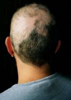Trichotillomania: podivná posedlost vytrháváním vlasů