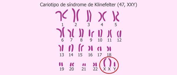 ゲノム変異：定義と例-クラインフェルター症候群：XXY性的トリソミー