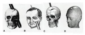 The Curious Case of Phineas Gage and the Metal Bar