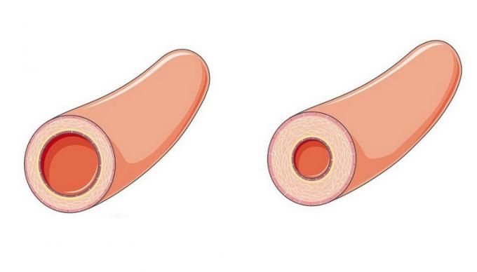 Hypertension syyt