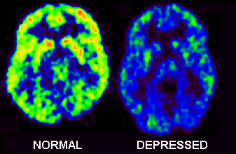 depresia-neuroimagén.gif