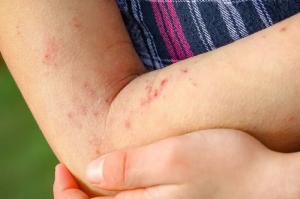 Røde flekker på huden: 25 mulige årsakssykdommer og symptomer